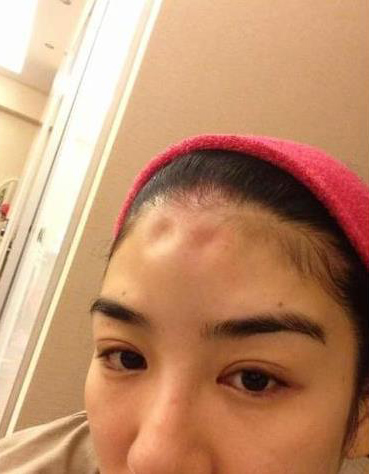 整容后遗症？黄奕近照脸部浮肿笑容僵硬惨不忍睹(4)